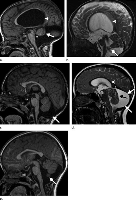 mega cisterna magna prognosis|Cystic Malformations Within the Posterior Fossa .